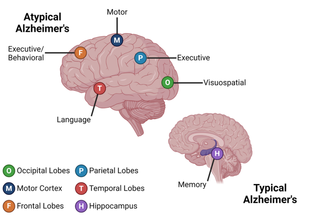 5 Types of Alzheimer’s Disease That Don’t Begin with Memory Loss