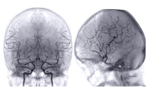 Brain's vascular system angiography.