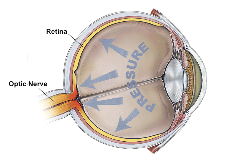 A cross-section diagram of a human eye. Inside of the eye reads "PRESSURE" with arrows pointing towards the back of the eye. The retina is labeled on the back left corner of the eye and the optic nerve is labeled leading out of the eye.