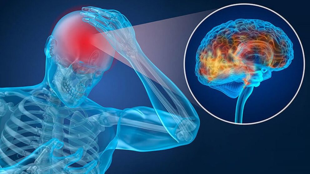 Concussions, Traumatic Brain Injuries, and Alzheimer’s Risk