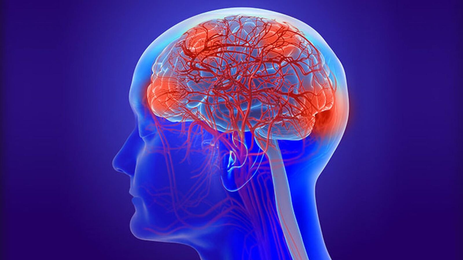 What Is Vascular Dementia What Is Vascular Dementia