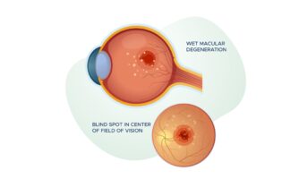 Macular Degeneration Signs & Symptoms | BrightFocus Foundation