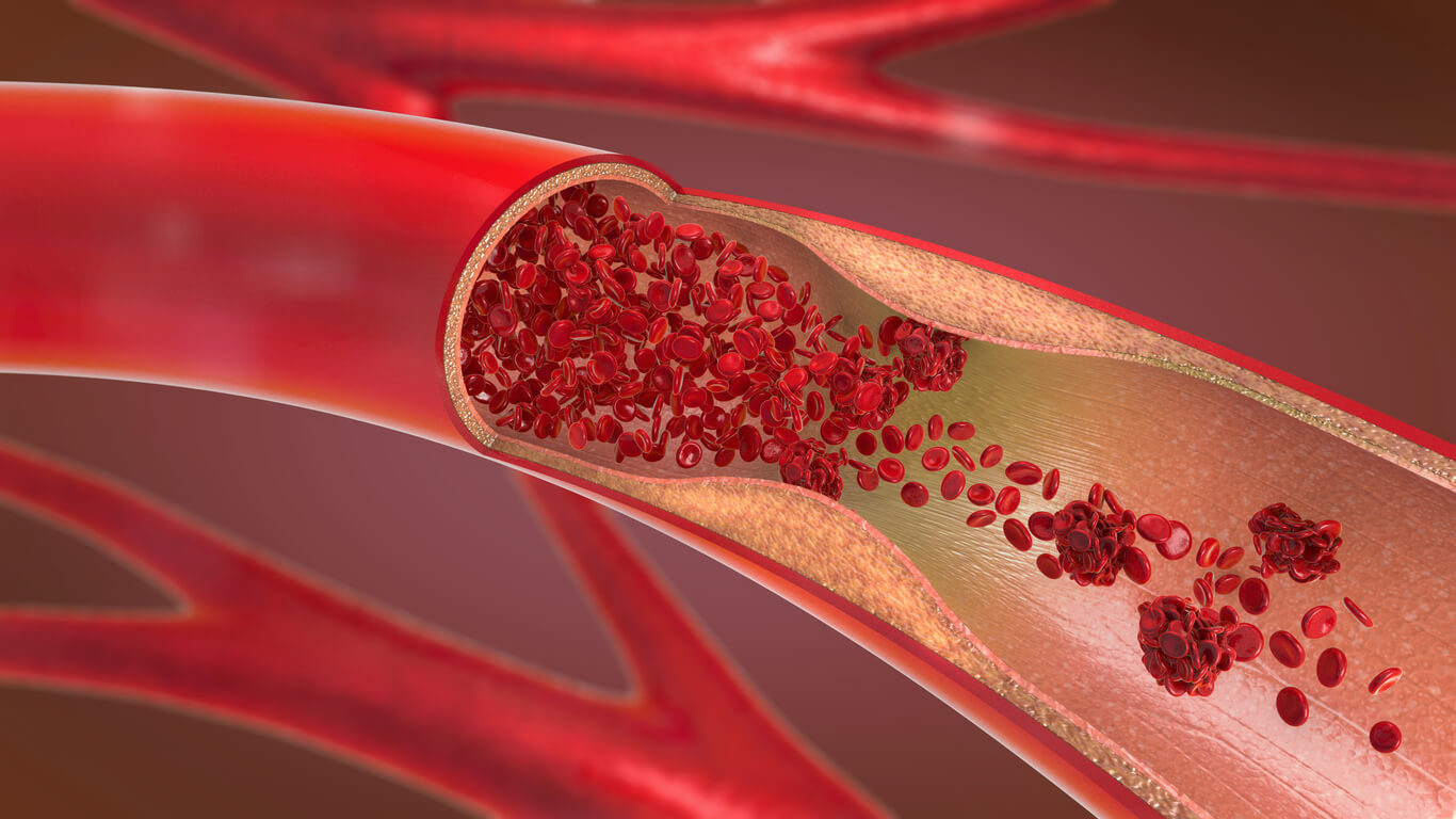 3d illustration of a constricted and narrowed artery and the blood cannot flow properly called arteriosclerosis.