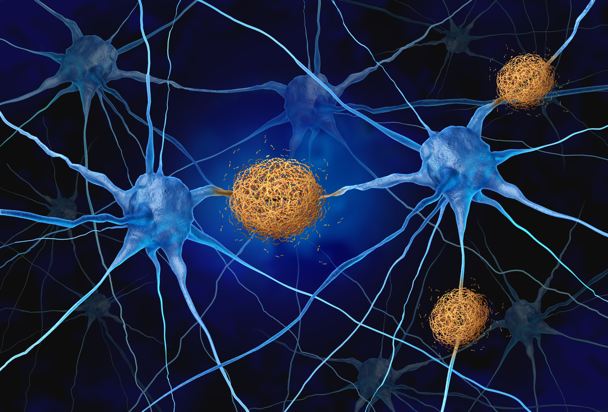 Amyloid plaques concept image.