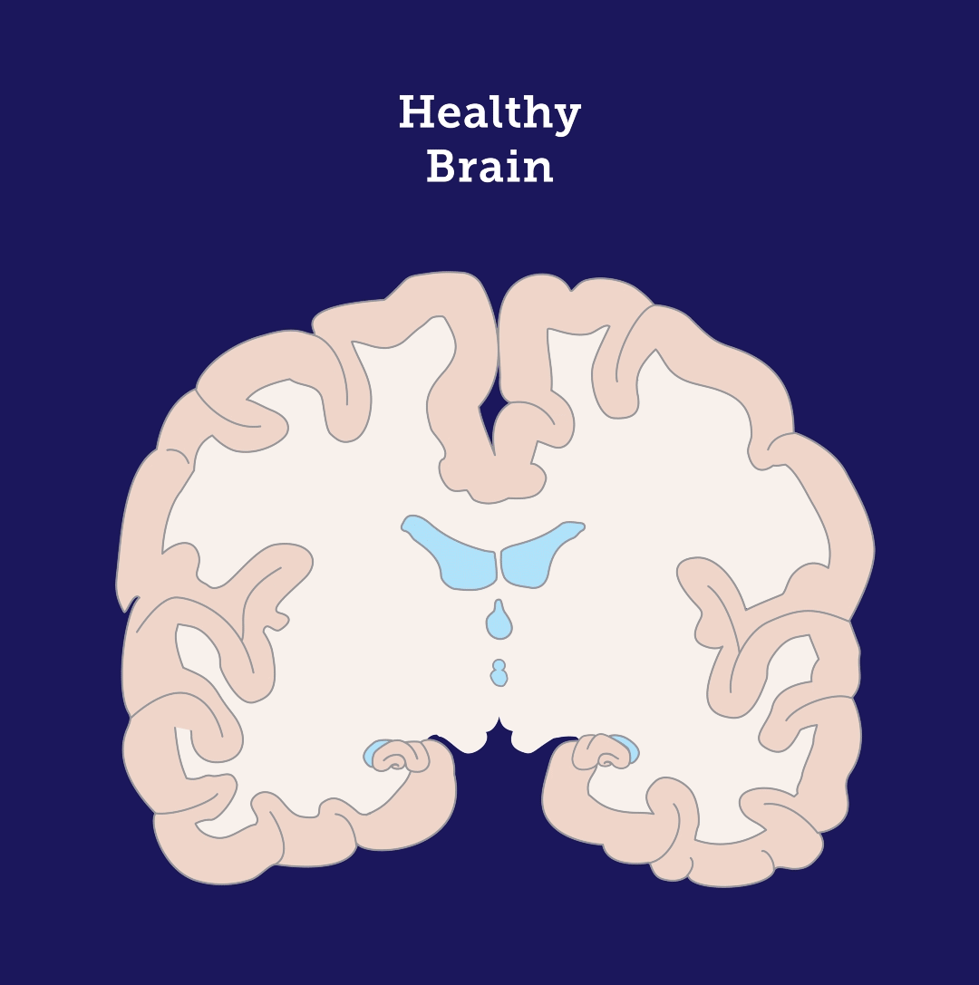 Animation of how Alzheimer's Disease changes the brain.
