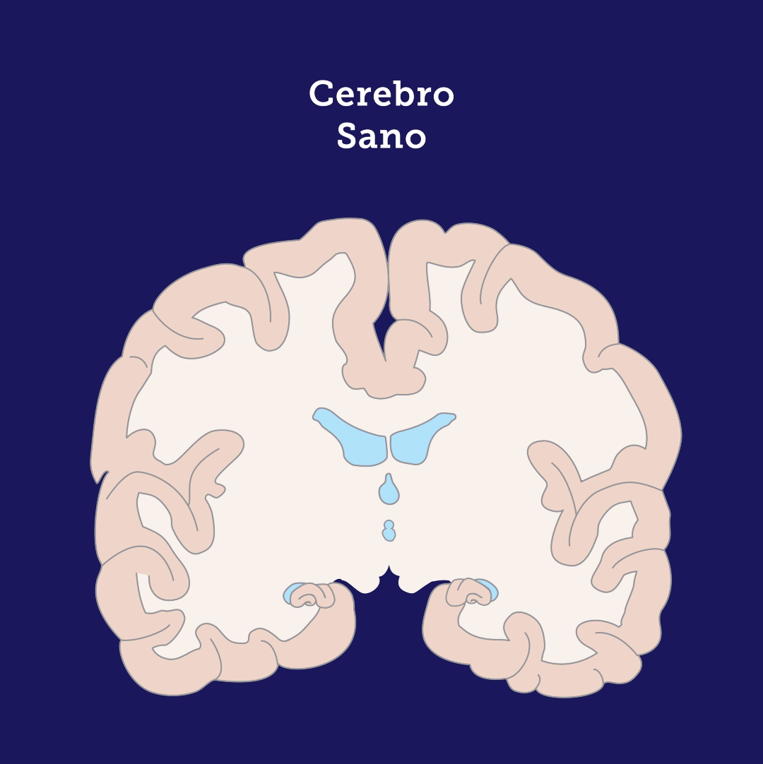 Animation of how Alzheimer's Disease changes the brain.